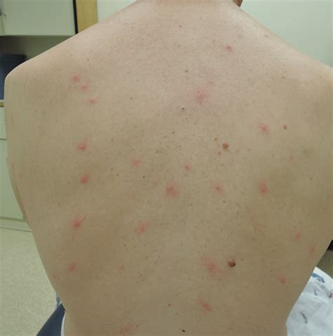 Larval Tick Infestation Causing An Eruption Of Pruritic Papules And