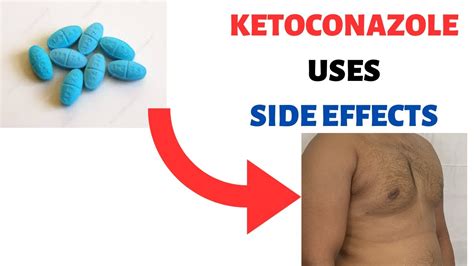 Ketoconazole Nizoral Uses Side Effects Review Shampoo Cream Soap