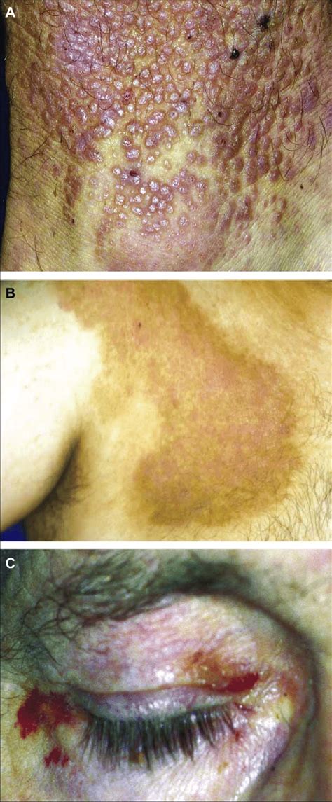 Clinical Presentation Lichen Amyloidosus Of The Lower Limbs A