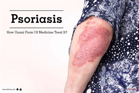 Effective Unani Medicine For Psoriasis Treatment By The Herbals Lybrate