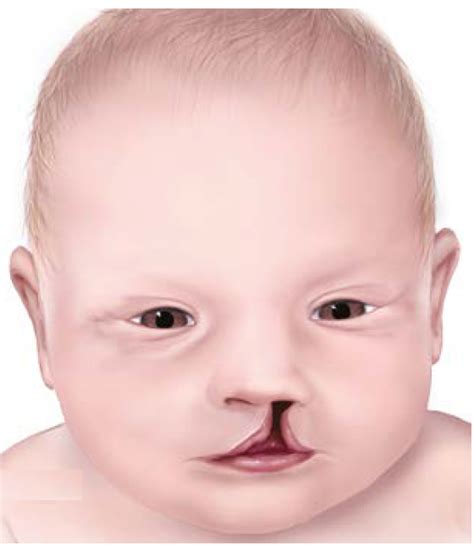 Facts About Cleft Lip And Cleft Palate CDC 6048 Hot Sex Picture