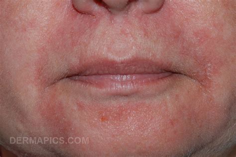 Perioral Dermatitis Pictures And Clinical Information From The Dermatology Department