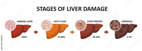 Stages Of Liver Damage Healthy Fatty Liver Fibrosis And Cirrhosis Stock Vector Adobe Stock