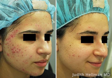 Acne Scars Before And After Photos New York
