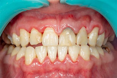 What Are The Treatment For Periodontitis Emergency Dentist