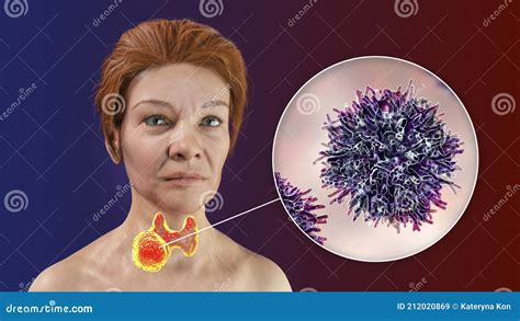Thyroid Cancer In Women Stock Illustration Illustration Of Disease