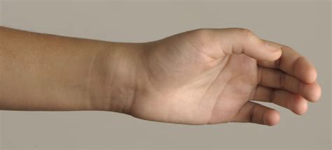 An Unusual Case Of Traumatic Wrist Swelling Archives Of Disease In