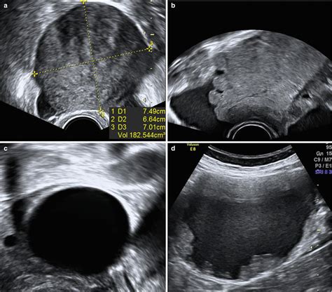 Ultrasound Evaluation Of Ovaries Obgyn Key
