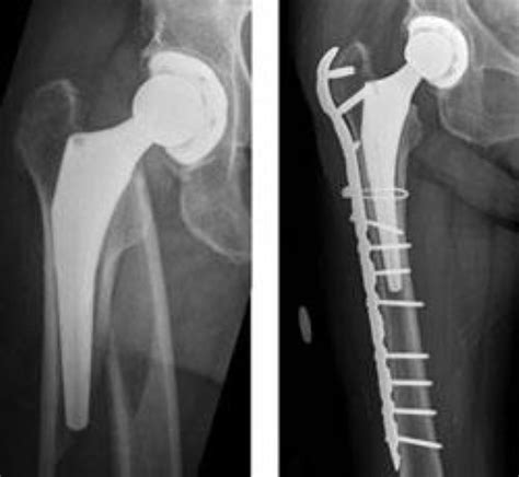 Fractures Around A Hip Replacement Adam Watson Orthopaedic Surgeon