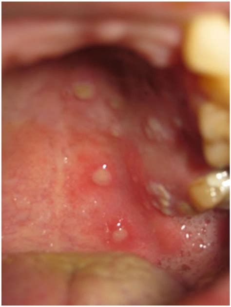Herpes Zoster On The Face In The Elderly Bmj Case Reports