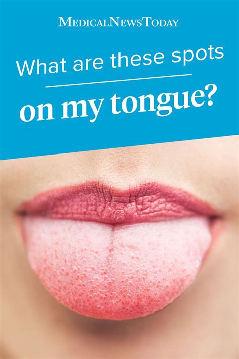 Bumps On Tongue Artofit