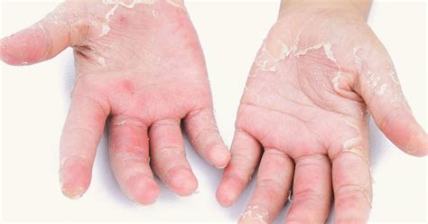 Treatment Psoriasis On Palms Of Hands