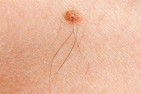When Should You Get Your Mole Checked Out