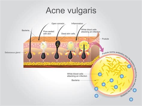 How To Treat And Manage Acne Vulgaris