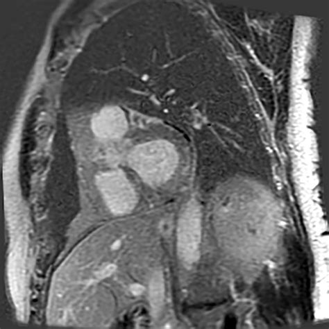 Cardiac Mri Showing Patchy Subepicardial Late Gadolinium Enhancement In