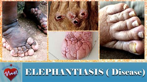 What Is Elephantiasis Disease Causes Symptoms And Treatment Of Elephantiasis Big Foot