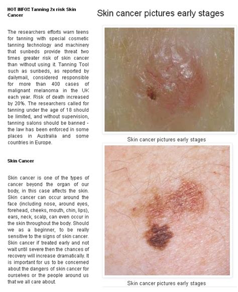 Skin Cancer As Related To Cancer Pictures