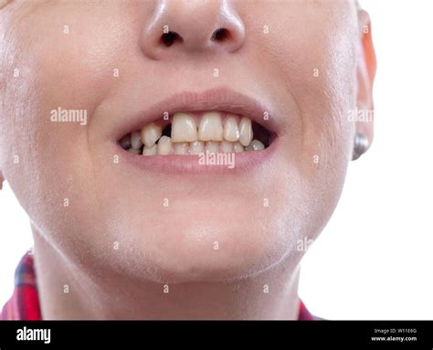 Tooth pain and dentistry, broken teeth – young woman broken teeth