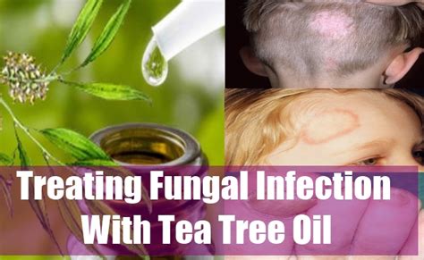 Fungal Infection Treatment Tea Tree Oil Nail Fungus Anti Fungal