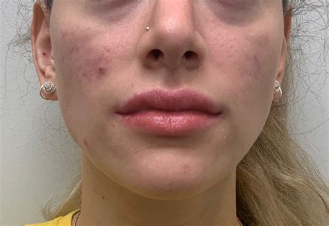 Erythematous Facial Rash Clinical Advisor