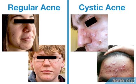 Regular Acne Vs Cystic Acne Whats The Difference