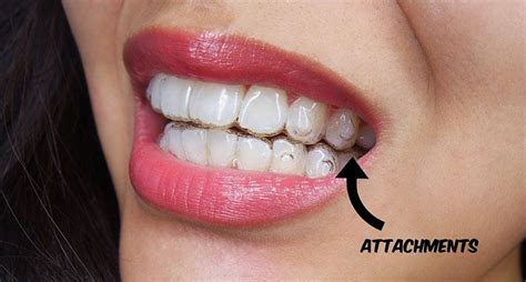 Everything You Need To Know About Invisalign Attachments Invisalign