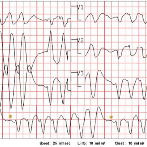 Twelve Lead Electrocardiogram On Admission A 12 Lead Electrocardiogram