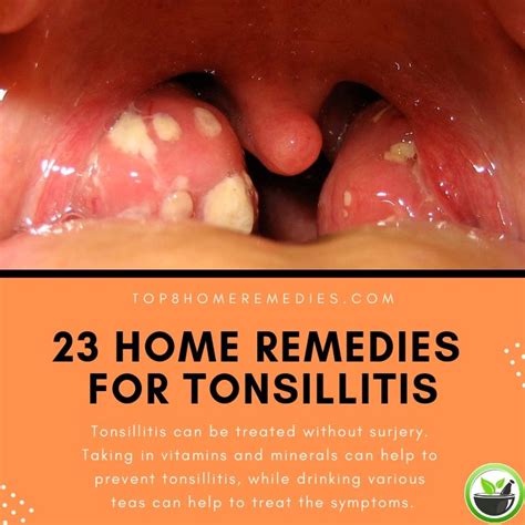 Learn How To Prevent Tonsillitis And Treat Its Symptoms With The Use Of
