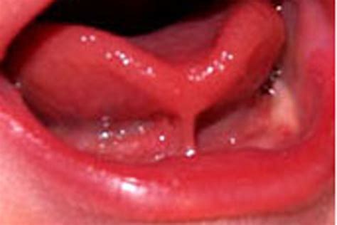 Couper Le Frein De La Langue - AA 95 : Freins de langue, freins de lèvre : des freins à l'allaitement