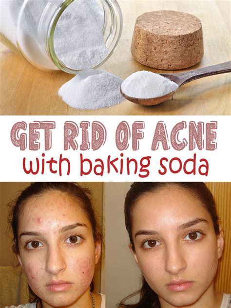 Get Rid Of Acne Using Baking Soda Homemadelifeproject