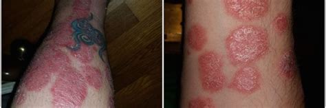 My Diagnosis And Treatment For Psoriasis The Mighty