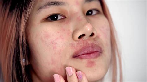Asian Woman Is Scratching Her Face From Skin Allergy Infected Illness