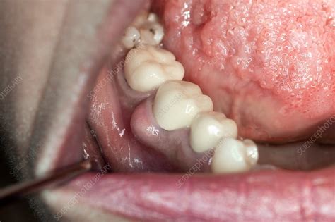 Dental Abscess Stock Image C0291867 Science Photo Library