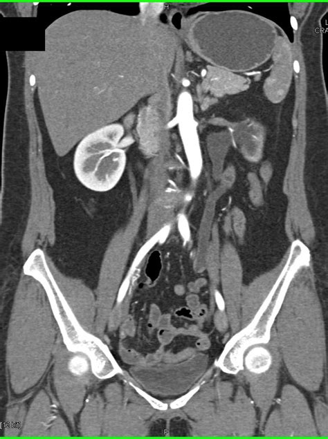 Transitional Cell Cancer Tcc Left Distal Ureter Genitourinary Case