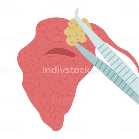 Vector Illustration Of Removing A Stone From The Parotid Salivary Gland