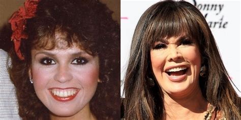 Did Marie Osmond Have Plastic Surgery Her Face Before And After