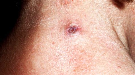 Image Gallery Epidermoid Cysts