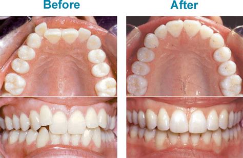 Add top braces (while keeping the herbst appliance in place). Invisalign: What It Is and What It Can Do For You