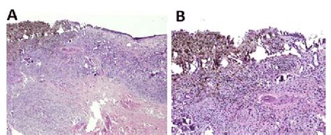 Histopathology Of The Lesion A Malignant Melanoma Adjacent To The