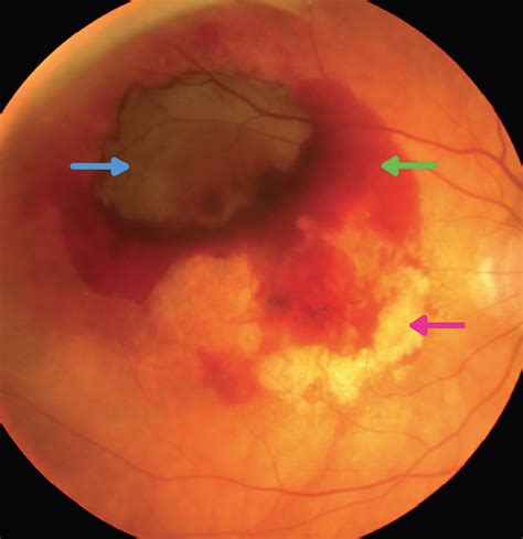 Check spelling or type a new query. The Impending Vision-Loss Cascade: A Review of Macular ...