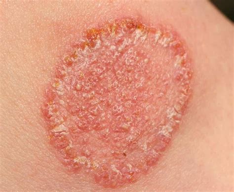 Fungal Infection Singhania Skin Clinic