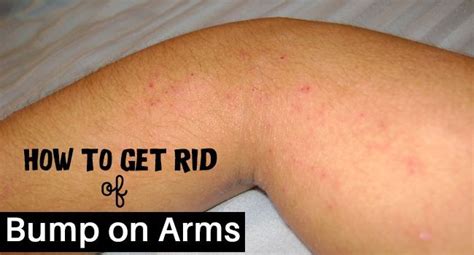 Have You Ever Waked Up With Bumps On Your Arms Or Legs You May Assume