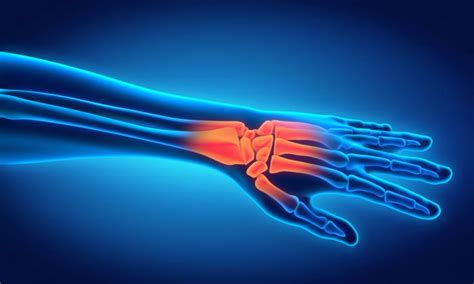 What Does Wrist Pain Mean Medical News Today