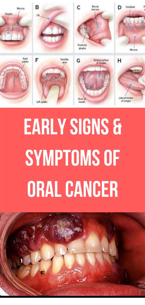 Early Signs And Symptoms Of Oral Cancer Wellness Rise