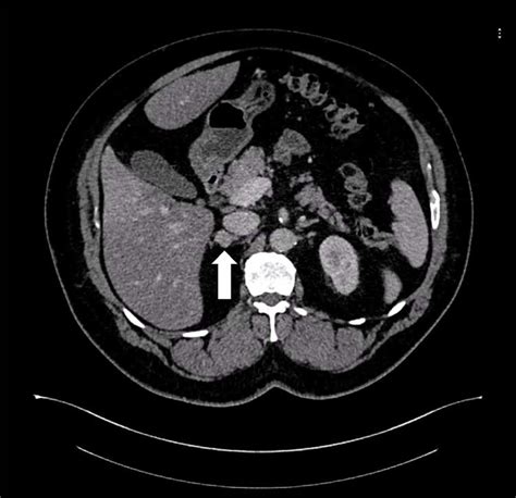 Axial Ct Of The Abdomen Showing The Right Adrenal Mass In Patient 2