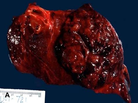 Tending to produce death:a malignant tumor. American Urological Association - Malignant Peripheral ...