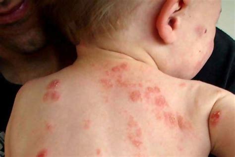 Faktor penyebab terkena penyakit bisul pada umumnya adalah. 5 Jenis penyakit kulit yang biasa menyerang bayi - SIMOMOT