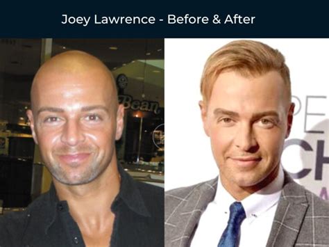 59 Celebrity Hair Transplants Before And After Photos