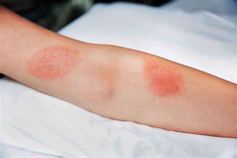How To Identify These Three Common Rashes