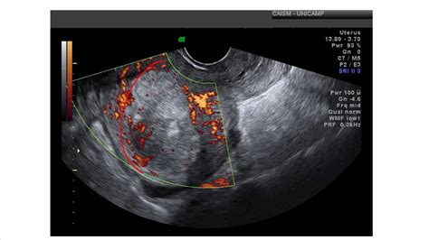 Papel Da Ultrassonografia Transvaginal No Rastreamento E No Diagnóstico